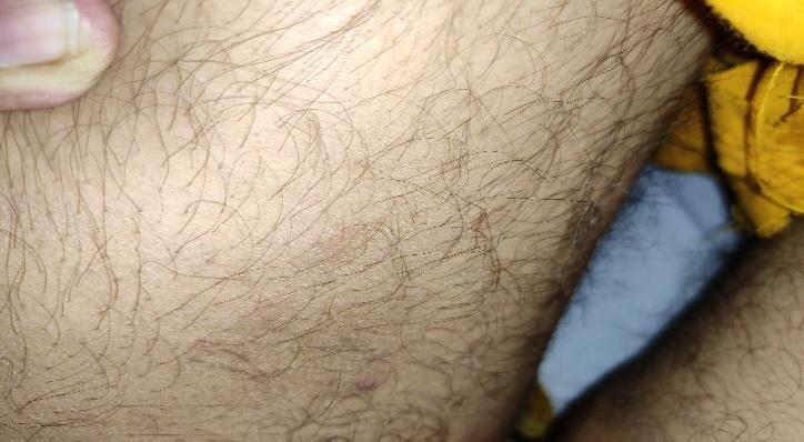 Figure 2: On the left thigh region.