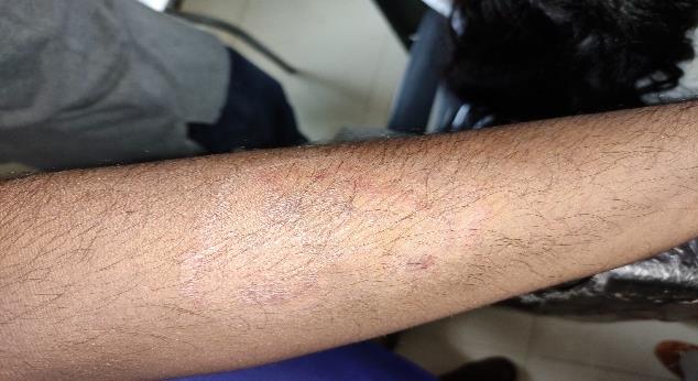 Figure 3: On the left forearm.