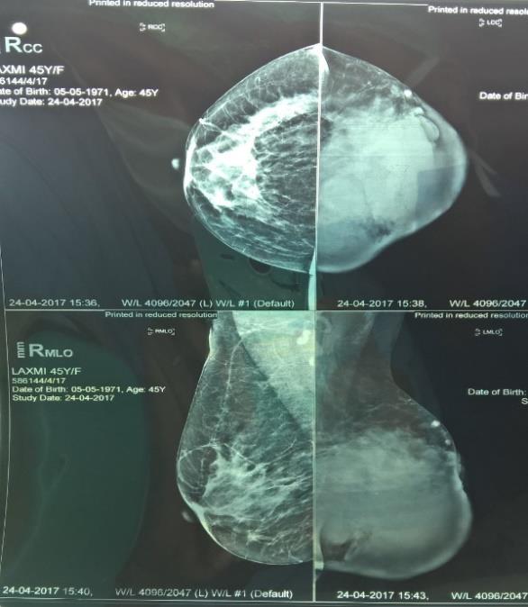 Figure 2: Diagnosis of benign phyllodes tumor.