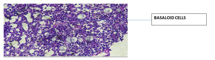 Figure 3: H&E Stain showing cystic spaces surrounded by basaloid cells having hyperchromatic nuclei (400x).