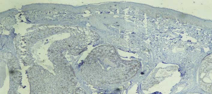 Figure 4: Immunohistochemistry for CD117 showing positivity in tumour cell (100X view).