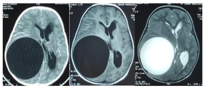 Figure 1: Axial CT (A), T1-weighted axial (B) and T2-weighted axial (C) images showing a giant right parietal cyst consistent with the diagnosis of hydatid cyst.
