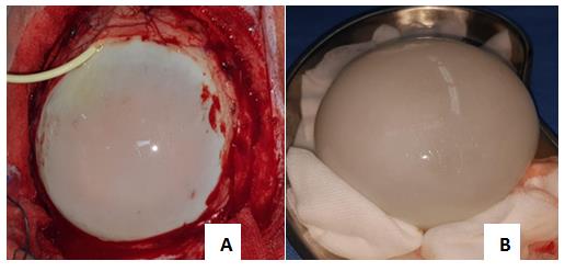 Figure 2: Hydrodissection of the cyst (A) macroscopic aspect of intact hydatid cyst after removal (B).