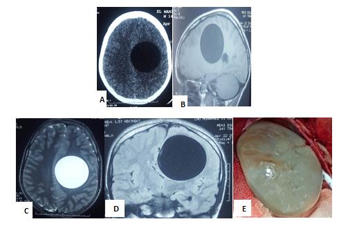 Figure 3: Axial CT-scan image (A), T1-weighted sagittal MRI (B) and T2-weighted axial MRI (C) showing a well- defined cystic lesion of the left frontoparietal area. No calcification and no wall enhancement are seen (D) Operative view of the cyst (E)