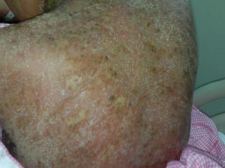 Figure 3: Plaque psoriasis showed: hyperkeratotic psoriatic plaques with silvery scales over the right knee and lower R. leg.