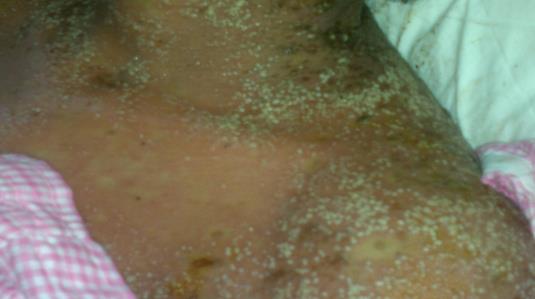 Figure 4: Pustular psoriasis showed: none follicular sterile pustules over the back, some lesions are exfoliated.