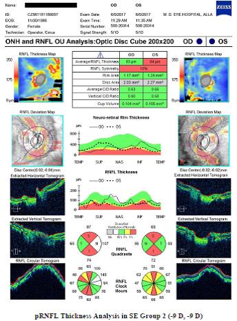 Figure 10: pRNFL Thickness Analysis in SE Group 2 (- 9 D, -9 D).