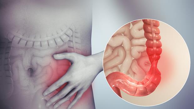 Figure 1: Irritable Bowel Syndrome [1-4].
