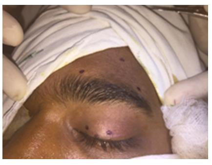 Figure 1: Measuring the incision point.
