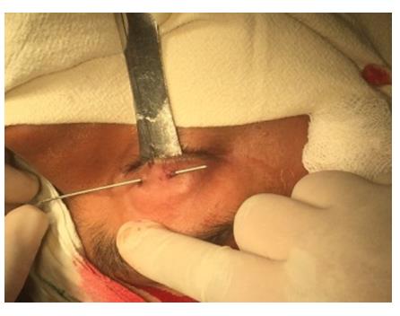 Figure 3: Stab incisions.
