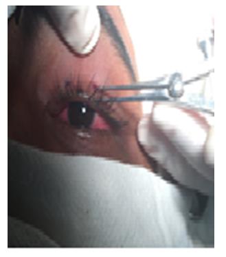 Figure 4: Needle passing through incision point.