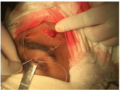 Figure 5: Needle passing through brow incision.