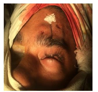 Figure 7: Frostbite Suture. Oral broad spectrum antibiotic were prescribed for all patients for 1 week. Topical antibiotics and lubricants were routinely used for the first week and then as required. Patients were followed up on 1st POD, 7th POD, and then after 1 month, 3 months and 6 months of surgery. Pre-operative and post-operative data has been recorded and then analyzed. Functional outcome were measured as good when MRD was more than1mm and poor when it was less than 1 mm. Cosmetic outcome were assessed according to eyelid symmetry, lid contour and lid crease formation. It was graded as excellent, good or poor based on follow up on 6th month.
