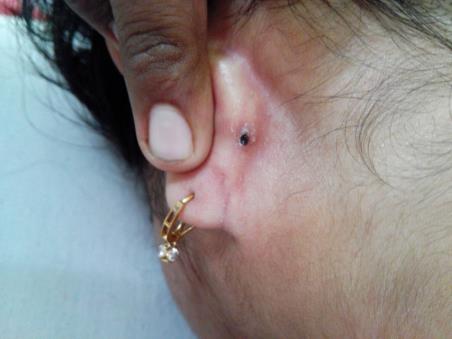 Figure 1: A black colored mole like appearance of tick.