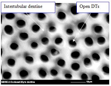 Figure 10: SEM micrograph of dentine sample (10µm magnification).