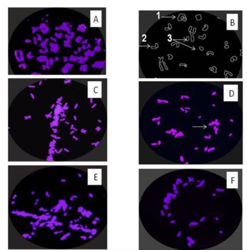 Figure 4: Chromosomes of the control group. A: scattered metaphase; B1: ring chromosome; B2: chromatide separations, B3 chromosomal break. Chromosomes of taxol group; C: agglomerated metaphase; D association of chromosomal endings. E; polyploidy; F: lack of chromosomal group and chromosomal viscosity.