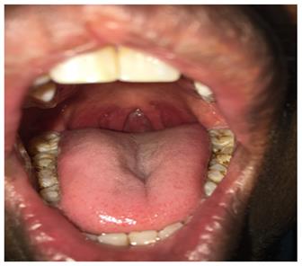 Figure 1: Absent uvula in oral cavity, parapharyngeal arch visible.