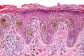 Figure 11: Spitz nevus with epidermal hyperplasia and epitheloid and spindle cell clusters abutting the dermal- epidermal junction [14].