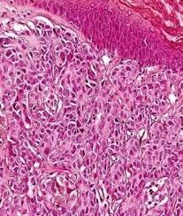 Figure 3: Spitz nevus with intradermal clusters and dissemination of epitheloid to spindle shaped cells [8].