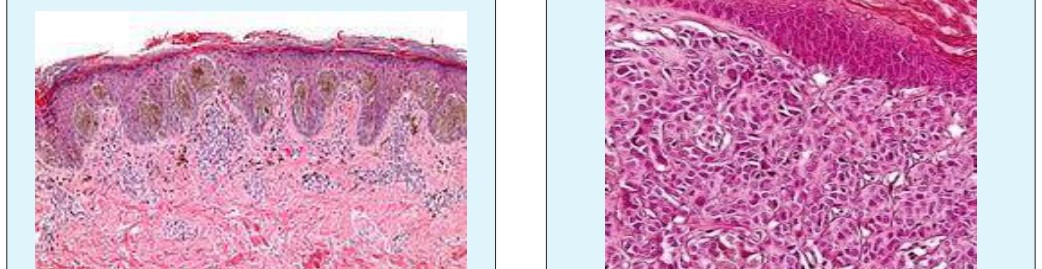 Figure 4: Spitz nevus with epitheloid cell dispersion, pigmented melanocytes and epidermal hyperplasia [9].
