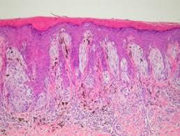 Figure 6: Spitz neoplasm with epidermal prominence, dermal epitheloid and spindle cell clusters with mild infiltrate at the dermal-epidermal junction [11].
