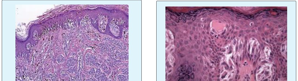 Figure 9: Spitzoid neoplasm, with pigmented melanocytes, epitheloid cell nests, moderation infiltration of the dermal- epidermal junction and hyperplasia of superficial epidermis [13].