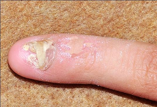 Figure 4: Treatment with infiltrations with 0.5cc triamcinolone acetonide We did not get an adequate response to this treatment and subsequently with the worsening of onycholysis and onychodystrophy, we finally decided the excision of the nail plate. Two months later, for our pleasant surprise, we found a suitable regrowth of the nail plate on the fifth finger of her right hand; around a 50% growth of healthy nail (Figure 5).
