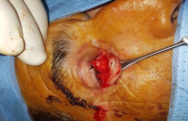 Figure 2: Subconjunctival step.