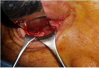 Figure 3: The periosteal incision is performed over the inferior orbital rim; the periosteum is elevated with a periosteal elevator toward the orbital floor.