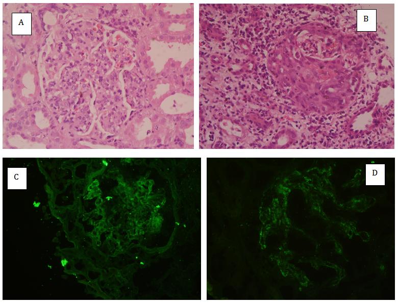 Figure 2: Immune complex mediated crescentic glomerulonephritis, A) Glomerulus with MPGN pattern B) Cellular crescent formation C) IgG deposition D) C3 deposition.