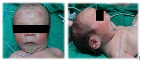 Figure 2: The infant that presents facial features of Miller-Dieker Syndrome.