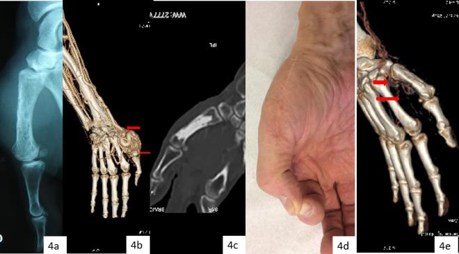 Figure 4: AVM of the 1rst metacarpal of right dominant hand in 30 years-old man. a- Initial digital radiograph: osteolytic foci and sclerotic lesions in diaphysis and metaphysis. b- Initial CT scan vascular in 3D with dominant AV shunt in the first metacarpal (arrow). c- Radiography after cementoplasty d- Functional result at 12 months with good mobility of the thumb. e- Control CT scan at 6 months: residual cortical arteries without residual intraosseous shunt (arrow).