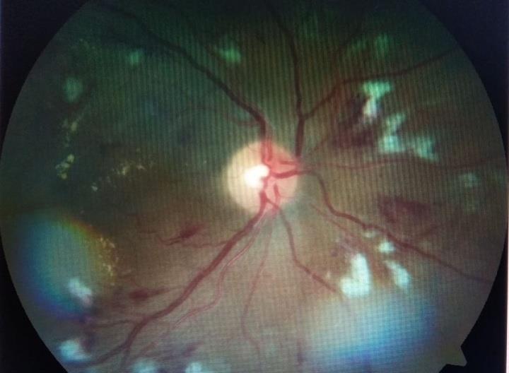 Figure 1: The fundoscopy showing some cotton wool spots following the path of dilated retinal blood vessels in the right eye.