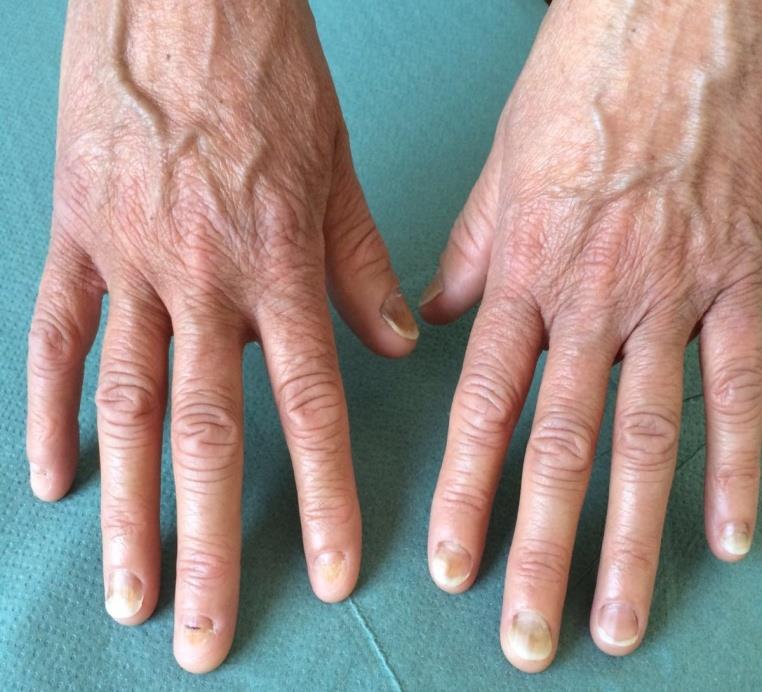 Figure 1: Taxane-induced onycholysis in a 45-year-old man causing half nail white detachment, and splinters hemorrhages of several fingers, including the thumbs.