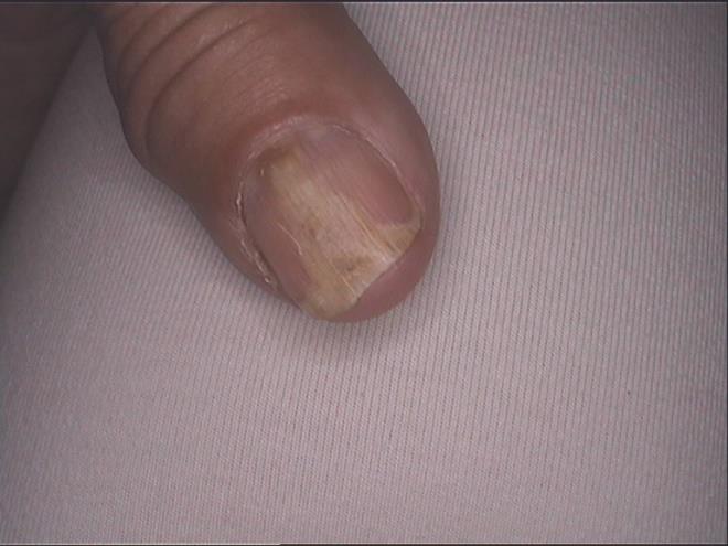 Figure 2: Proximal extension of the onycholysis in a taxane exposed woman.