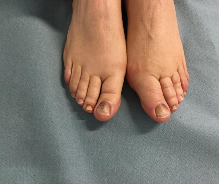 Figure 3: Involvement of the feet in the same patients, with painful subungual hemorrhages and distal onycholysis of the big toes. An additional event is the interaction with ultraviolet radiation for photosensitive chemical agents, resulting in a photo-onycholysis [9]. The nail plate is completely transparent to the light, without natural sunscreen, and may even concentrate the solar radiation acting as a lens, thus reaching the photosensitizers in the nail bed. By chance, this kind of reaction is quite uncommon in respect to the list of drugs potentially able to induced it (Table 2), including out-of-the counter non-steroidal anti- inflammatories. Photo-onycholysis is rare in dark-skinned individuals [8]. Agents most often associated with photo- onycholysis usually cause also systemic photo toxicity, but nails changes can occur after a longer time-lapse and sometimes when the drug has been dismissed, because of the different concentration and persistence of the drug in the nail bad and plate. It usually regresses after discontinuation of the causative agent. Clinical presentation is super imposable to conventional onycholysis, although severe pain and hemorrhagic blisters are more frequent, and thumbs are often spared (Figure 4), probably because of their less directly exposed positioning.Three patterns of photo-onycholysis are described [8] although in our experience, same patient presents with a variable mixture of these findings: Type I: Involvement of several digits, with a distal half- moon shaped detachment surrounded by a well- demarcated pigmented zone. Type II: Only one digit is involved and present as a proximal circular notch. Type III: Several digits are involved, but changes are located in the central part of the nail bed, usually associated with subungual hemorrhages.