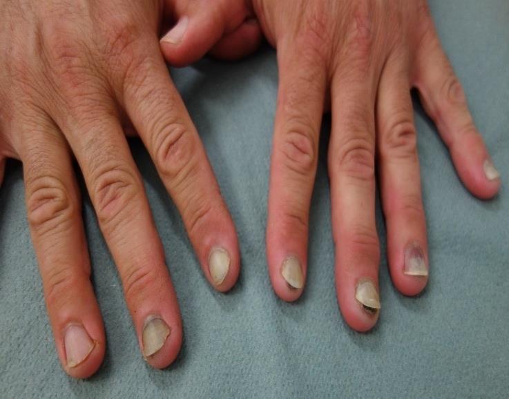 Figure 4: Photo-onycholysis during psoralen phototherapy: sparing of the thumbs, half-moon shaped detachment of some digits, proximal pigmentation and circular notch of the 3rd digit of the left hand, subungueal hemorrhages with complete central part of the nail bed of the 2nd and 3rd finger of the right hand. Variable severity probably depends on hands positioning during UV exposure.