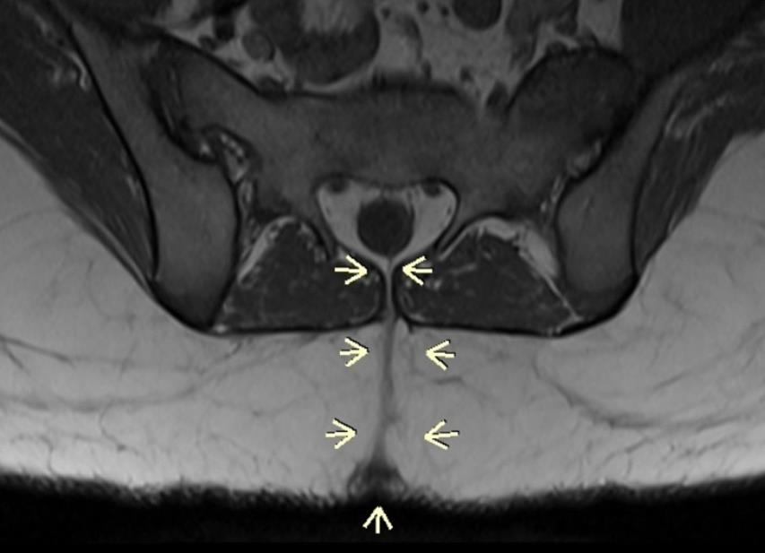 Figure 1: MRI, axial projection. Presence of dermal cyst and fistulae directly communicating with the sacral channel.