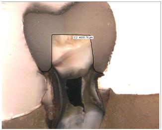 Figure 6: Total length of restoration in a sectioned tooth under stereomicroscope.