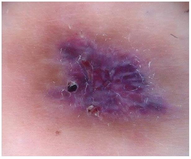 Figure 2: Dermatoscopic image: “rainbow pattern” and “crystalline structures”.