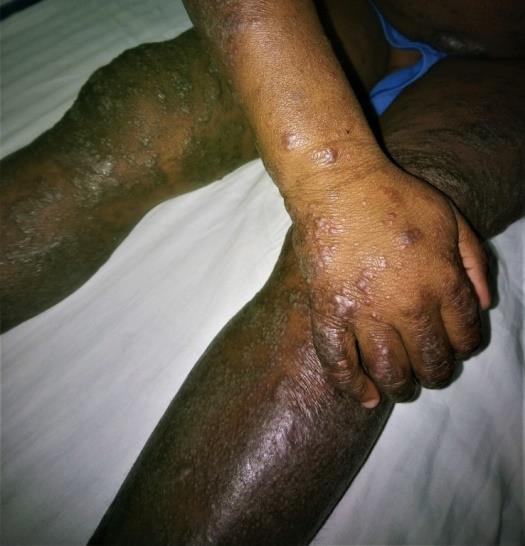 Figure 1: Severe lichenoid atopic dermatitis in a 4 years-old child.