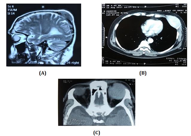 Figure 2: Initial presentation (A) MRI brain showing soft tissue mass at parietel region, (B) CECT Thorax showing soft tissue density at left thoracic wall, (C) CT orbit showing space occupying leison in left orbit.