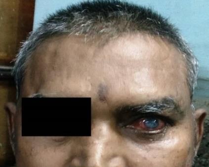 Figure 4: Presentation of the left eye after one month of chemotherapy and after 3 months.