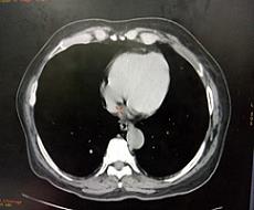 Figure 5: After one month of treatment imaging study showed complete resolution of mass (A) MRI brain, (B) CT thorax, (C) CT orbit.