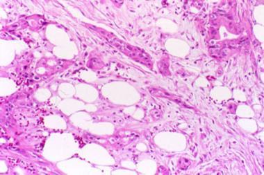 Figure 1: Carcinoma pancreas with glandular configuration, nuclear hyperplasia, hyperchromasia, anisonucleosis and tumour associated desmoplasia [9].