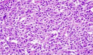 Figure 3: Carcinoma pancreas with neuro-ectodermal differentiation with miniature round cells, scant cytoplasm, uniform nuclei and a circumscribing fibro- vascular stroma [11].