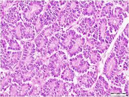 Figure 4: Acinar carcinoma pancreas with solid sheets and glandular pattern of tumour cells with abundant eosinophilic cytoplasm, scanty stroma and absent desmoplasia [11].