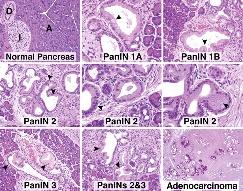 Figure 7: Carcinoma pancreas with acini and neoplastic glandular structures with nuclear hyperplasia, hyperchromasia, anisonucleosis, mucin secretion and minimal desmoplasia [13].