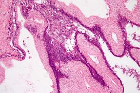 Figure 8: Carcinoma pancreases with transition between various stages of normal pancreas, grades of pancreatic intraepithelial neoplasm and frank adenocarcinoma [14].