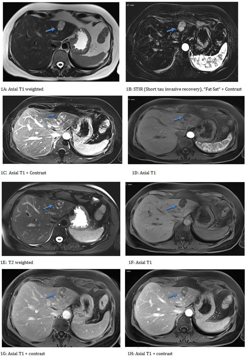Figure 1: MR-In the left hepatic lobe on the II segment, a 2.9 x 2.3 cm diameter hyperintense focal lesion is found in T1, T2, (Figures 1A-1E) and hypointense in T2 Fat sat (Figure 1B). With significant signal strength decay in opposite phase sequences and VIBE T1 sequences (Figures 1F-1J).